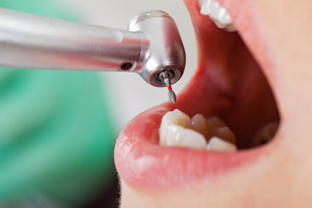 Best Emergency Tooth Extraction in Arnaudville, LA